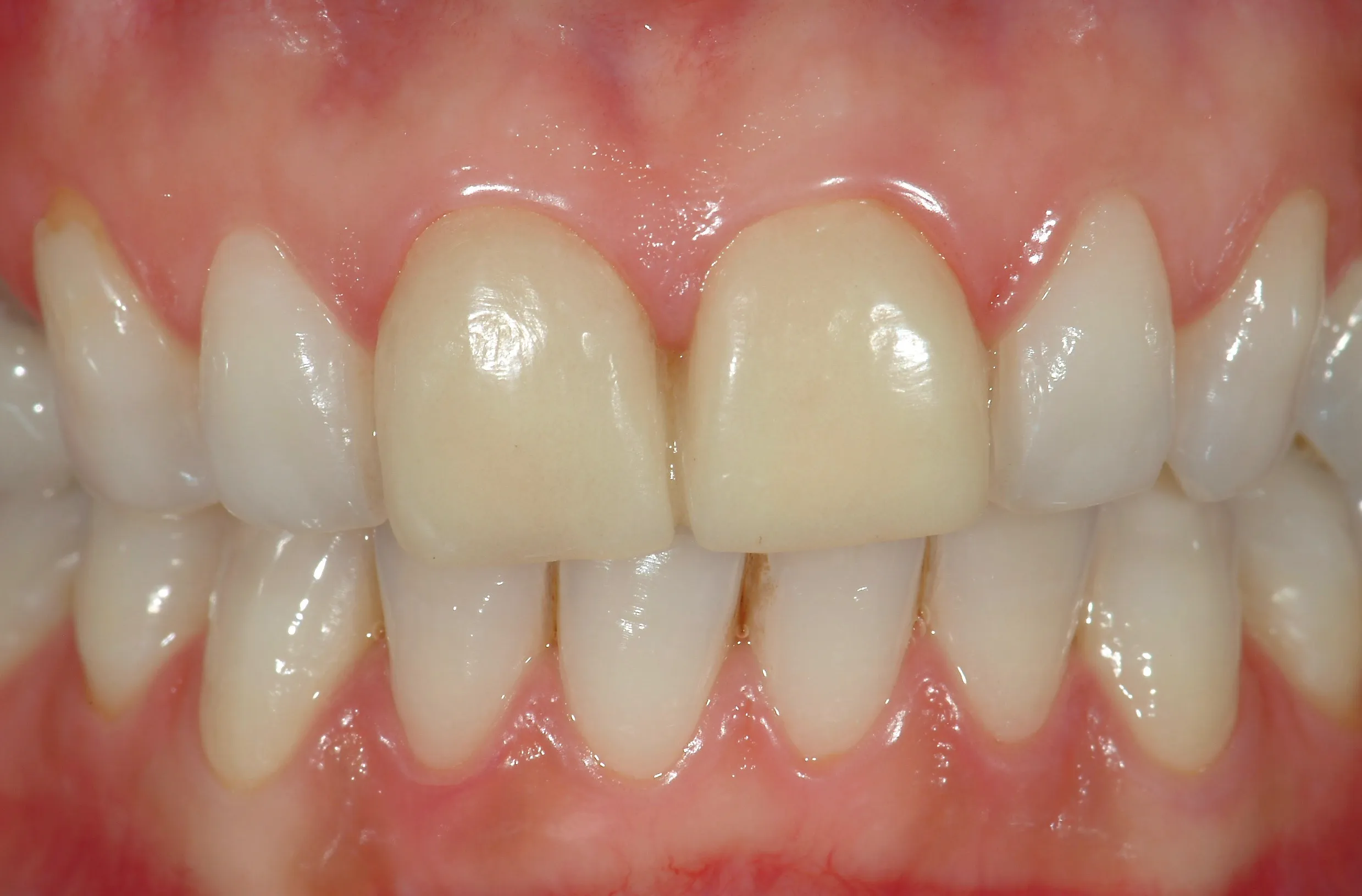 Prima del trattamento - Restyling degli incisivi centrali